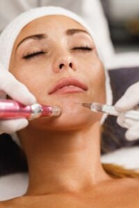Post-care routine after microneedling treatment in Aliso Viejo, CA