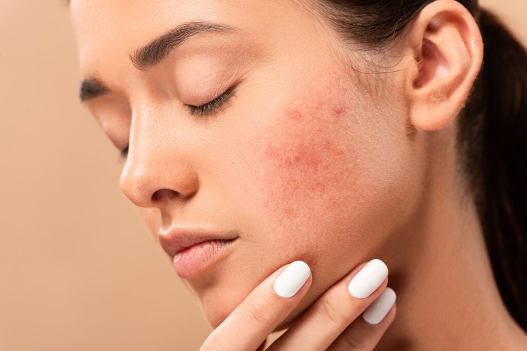 Alladerm chemical peel treatment for acne scars in Aliso Viejo, CA