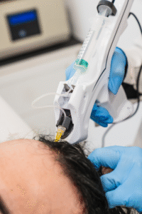 Alladerm Spa performing advanced skincare and hair restoration services in Orange County