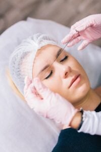 Non-surgical PDO thread lift treatment performed at Alladerm Orange County aesthetic clinic