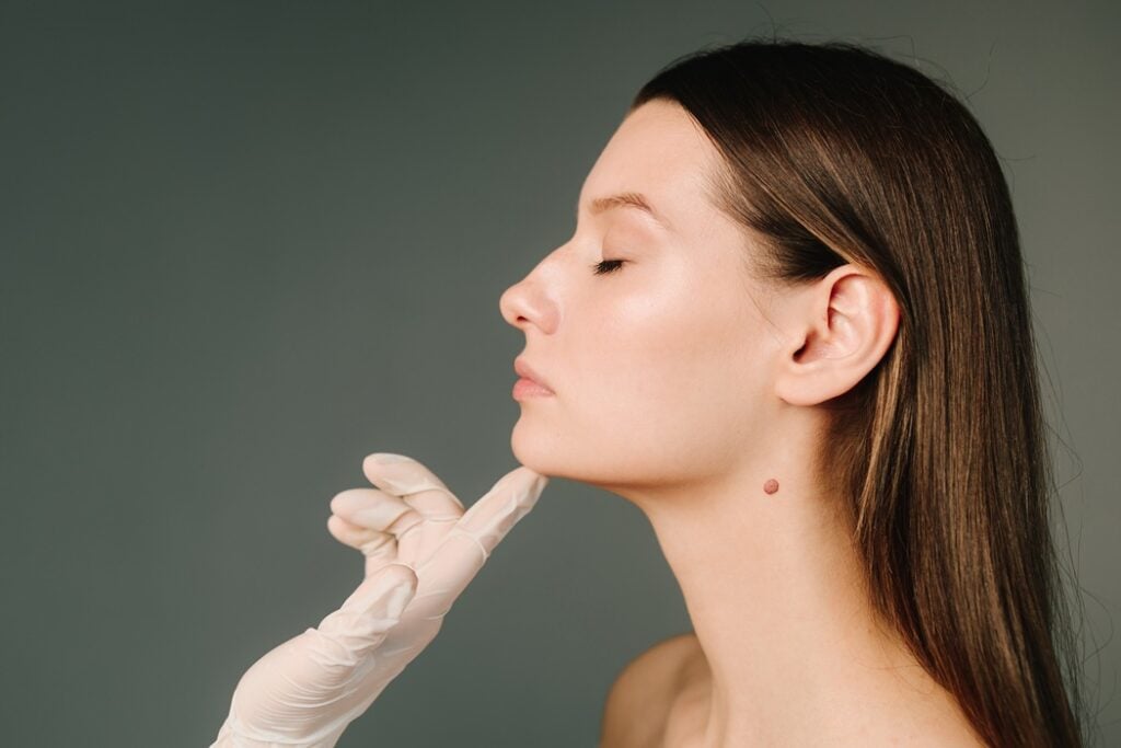 Cheek and chin filler treatment for facial contouring by Alladerm in Orange County