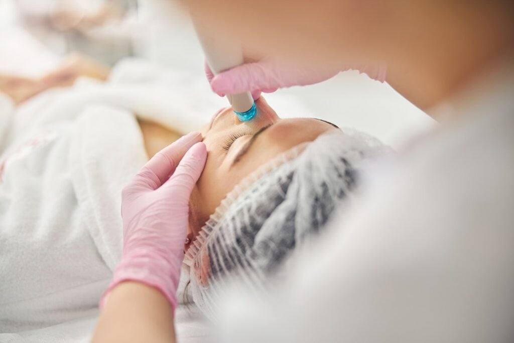 Professional microneedling treatment at a skincare clinic in Aliso Viejo, CA