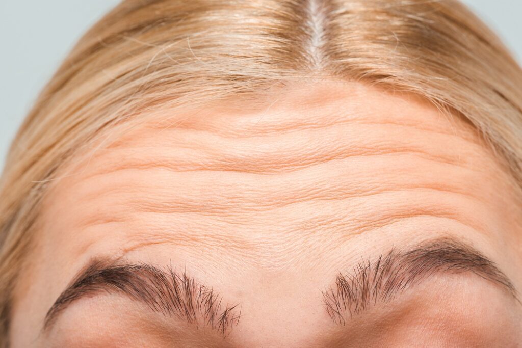 Close-up of forehead wrinkles and fine lines treated at Alladerm
