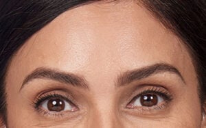 forehead after treatment from Skin Specialist at Alladerm